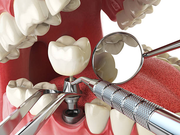 Best Emergency Treatment for Toothache in Frankfort, KY