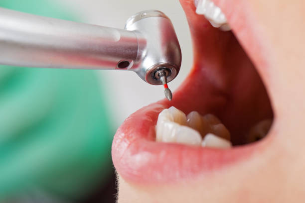 Best Emergency Broken Tooth Repair in Frankfort, KY